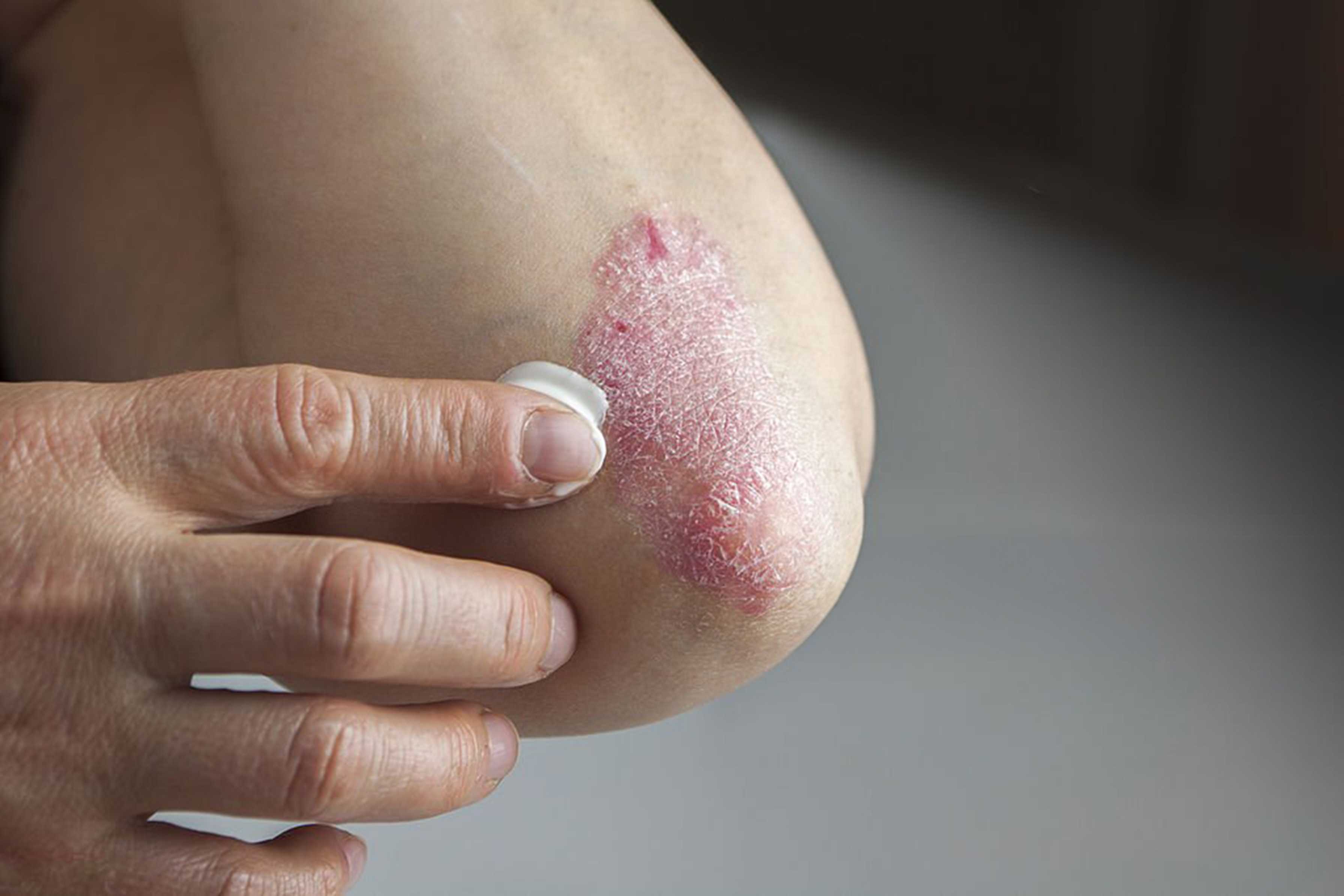 Eczema Treatment Image
